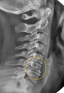 X-ray narrowing of the intervertebral space