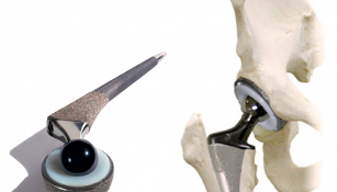 Endoprosthetics of the hip joint in osteoarthritis