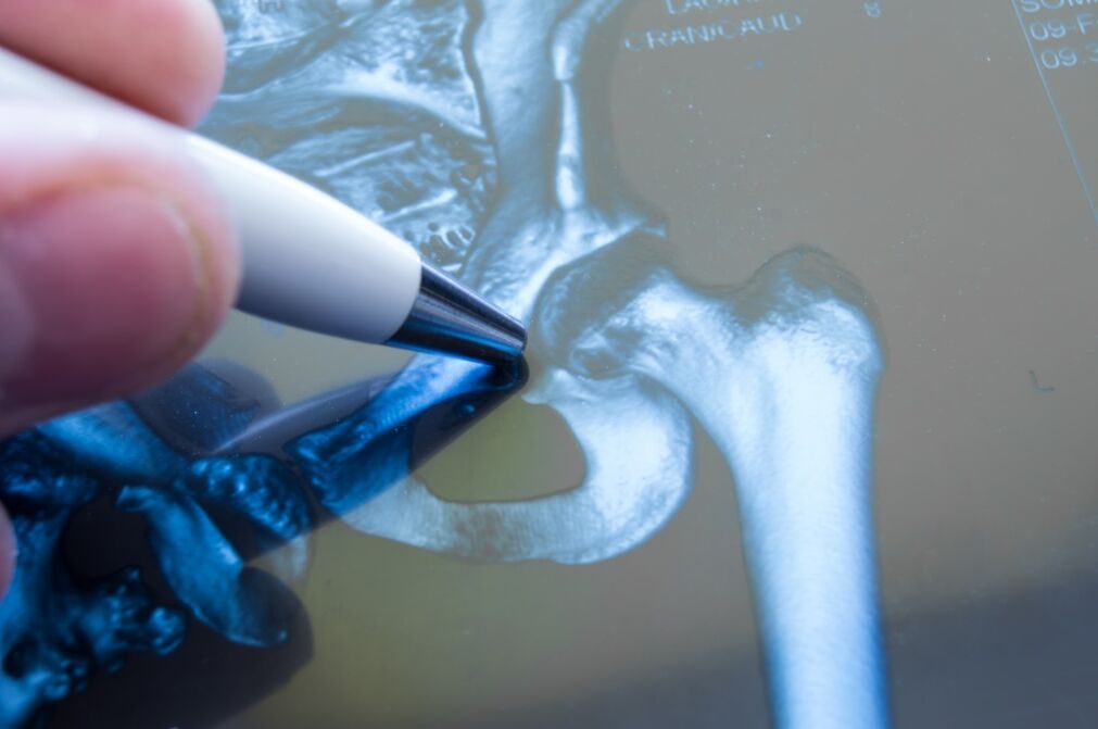 Arthrosis of the hip joint on the x-ray