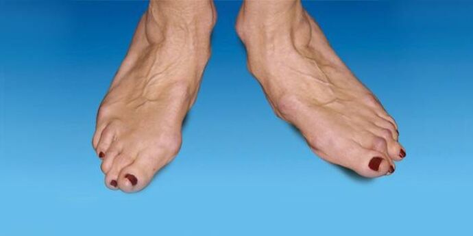 Foot malposition in ankle arthrosis