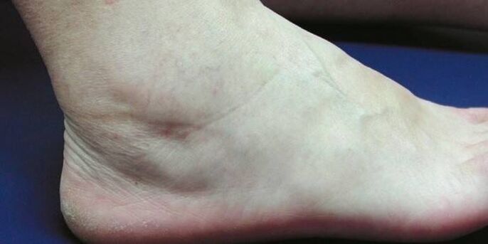 Swelling of the ankle joint with osteoarthritis