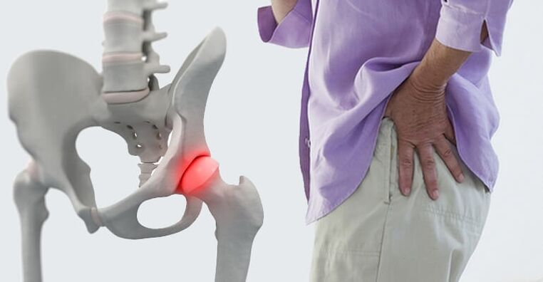 Hip pain - a symptom of osteoarthritis of the hip joint