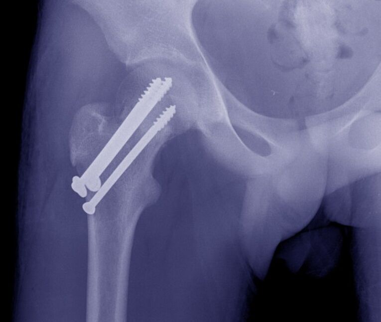 X-ray of the hip joint, osteosynthesis of the fracture with internal fixators