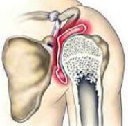 Osteoarthritis of the shoulder