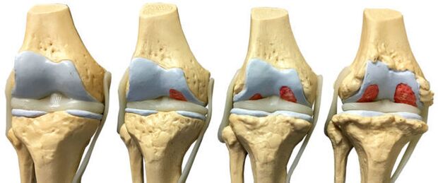 Joint damage in various stages of development of ankle arthrosis