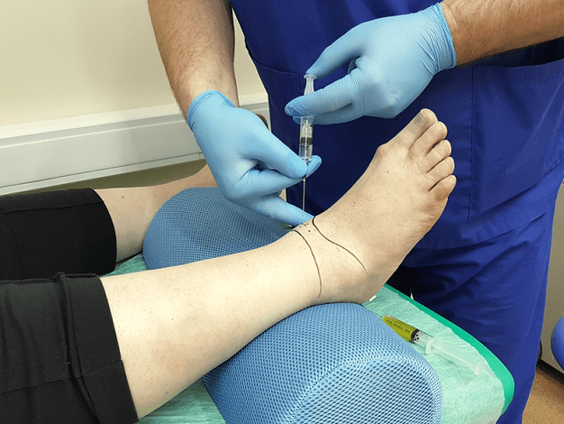 Puncture for osteoarthritis of the ankle