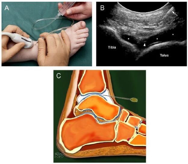 Ultrasound of the ankle for osteoarthritis