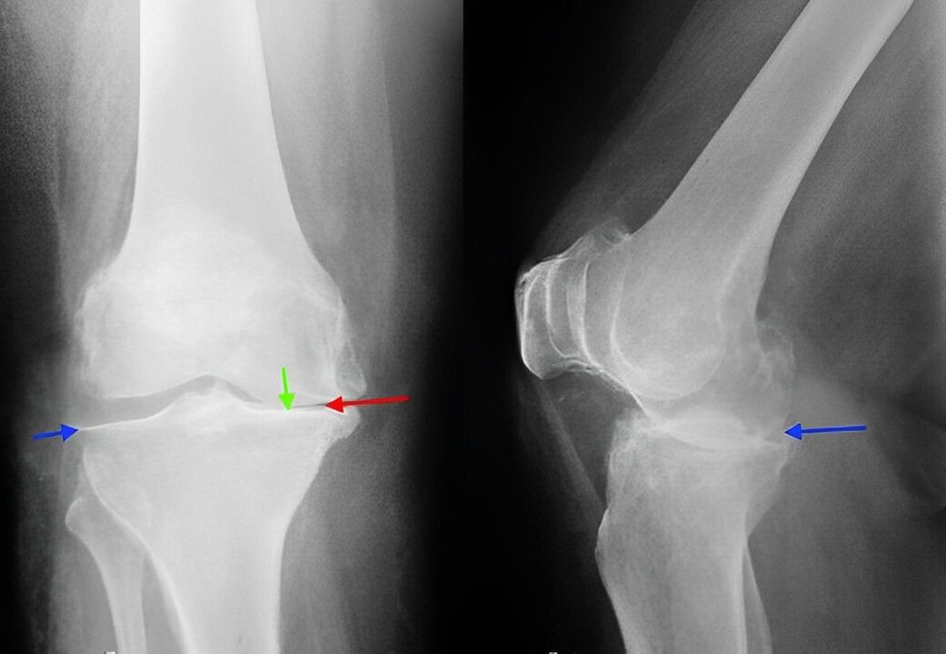 X-ray image of osteoarthritis of the knee joint