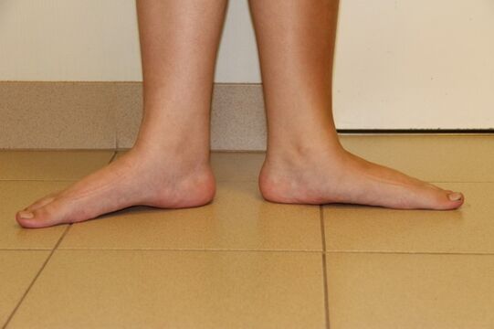Sometimes flat feet are the cause of neck osteoarthritis