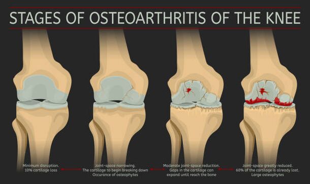 Development of joint arthrosis