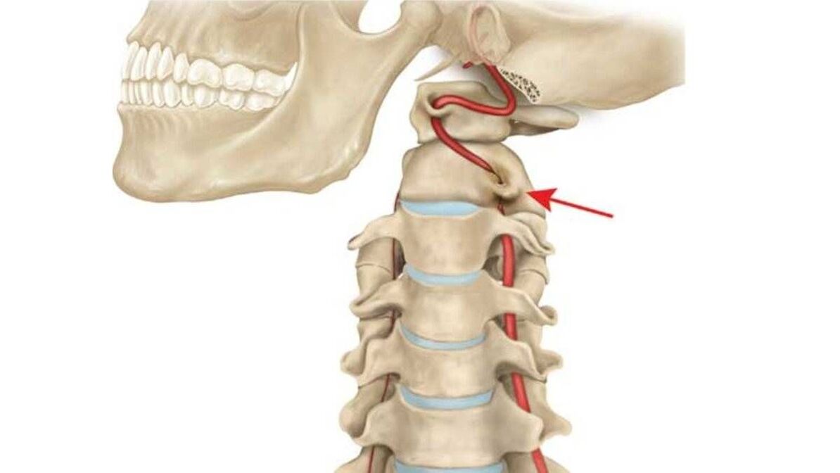 Osteochondrosis of the cervical spine