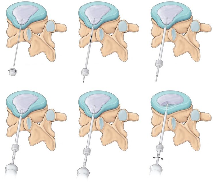 Surgery for back pain